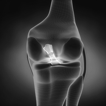 x-ray of a torn acl